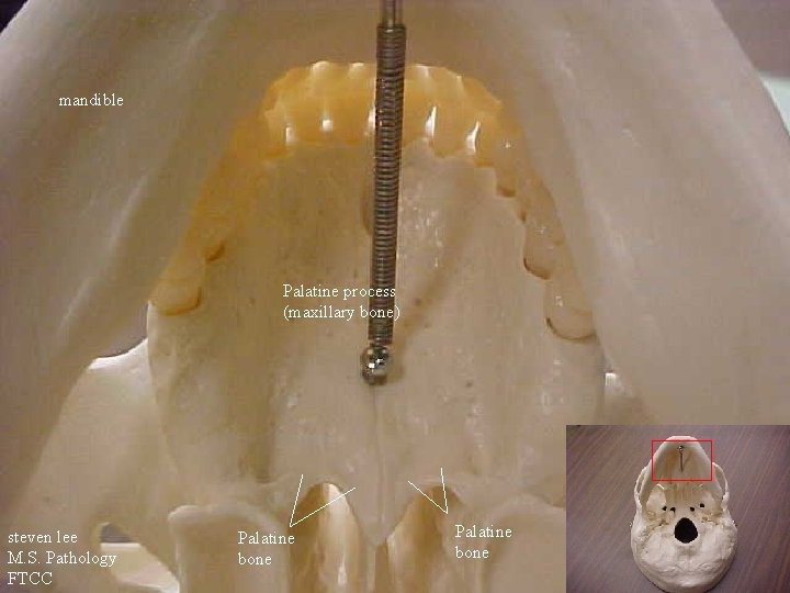 mandible Palatine process (maxillary bone) steven lee M. S. Pathology FTCC Palatine bone 