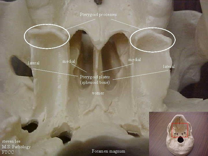 Pterygoid processes lateral medial lateral Pterygoid plates (sphenoid bone) vomer steven lee M. S.