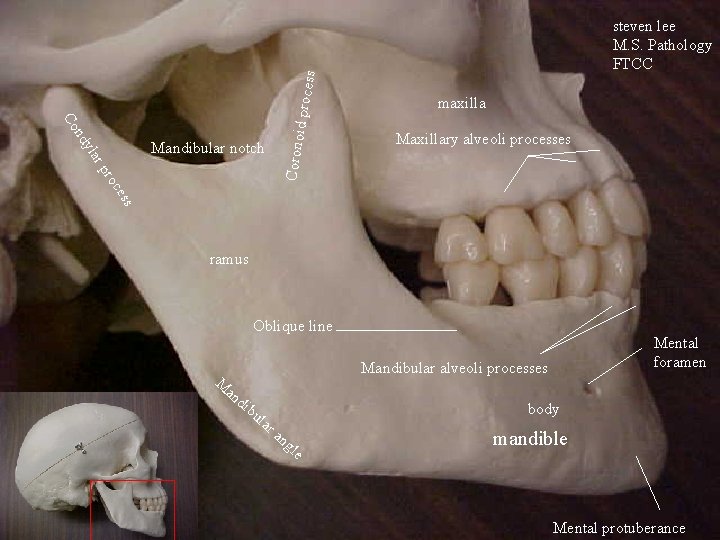 id proce ss maxilla Maxillary alveoli processes ess roc rp yla Corono nd Co