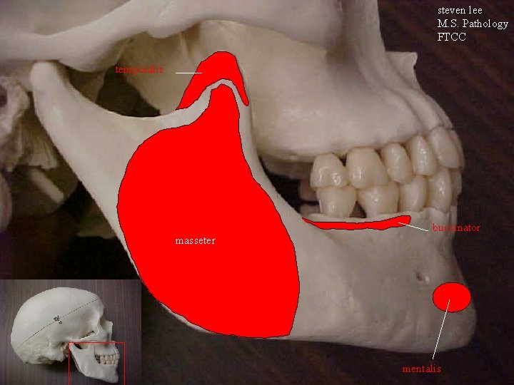 steven lee M. S. Pathology FTCC temporalis buccinator masseter mentalis 