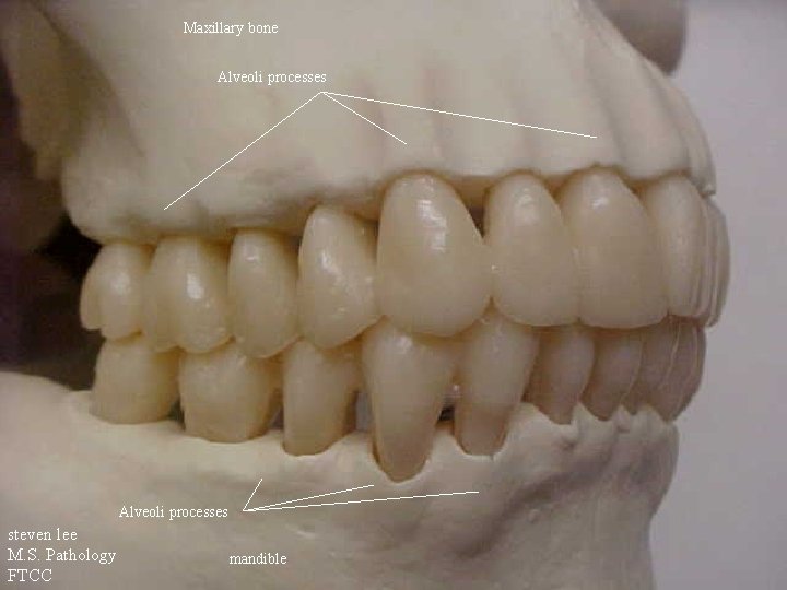 Maxillary bone Alveoli processes steven lee M. S. Pathology FTCC mandible 