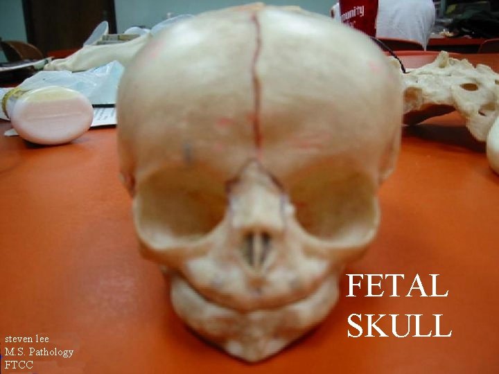 steven lee M. S. Pathology FTCC FETAL SKULL 