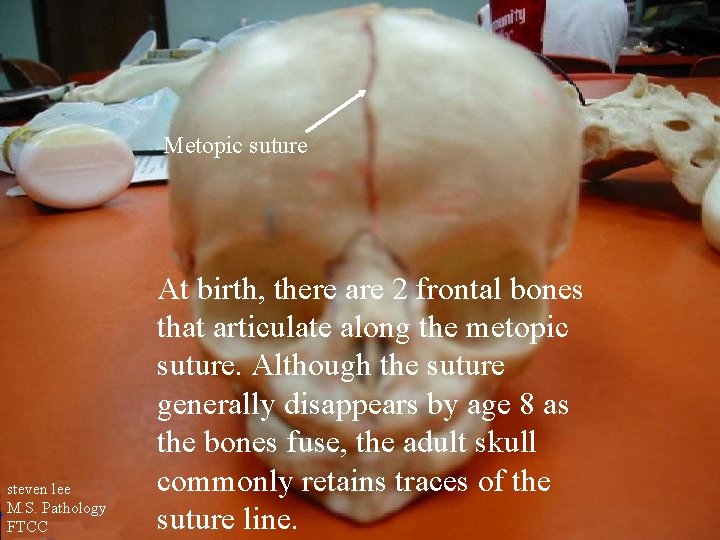 Metopic suture steven lee M. S. Pathology FTCC At birth, there are 2 frontal