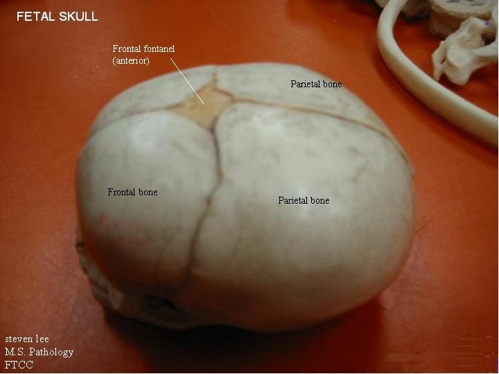 Frontal fontanel (anterior) Parietal bone Frontal bone steven lee M. S. Pathology FTCC Parietal