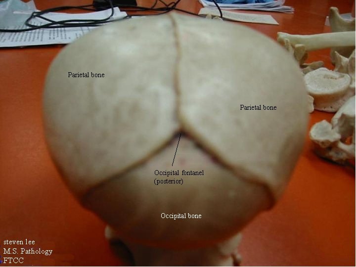 Parietal bone Occipital fontanel (posterior) Occipital bone steven lee M. S. Pathology FTCC 