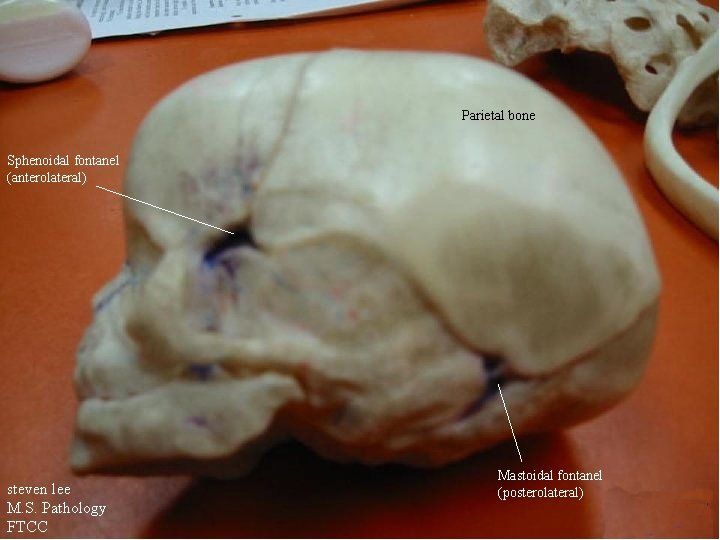 Parietal bone Sphenoidal fontanel (anterolateral) steven lee M. S. Pathology FTCC Mastoidal fontanel (posterolateral)