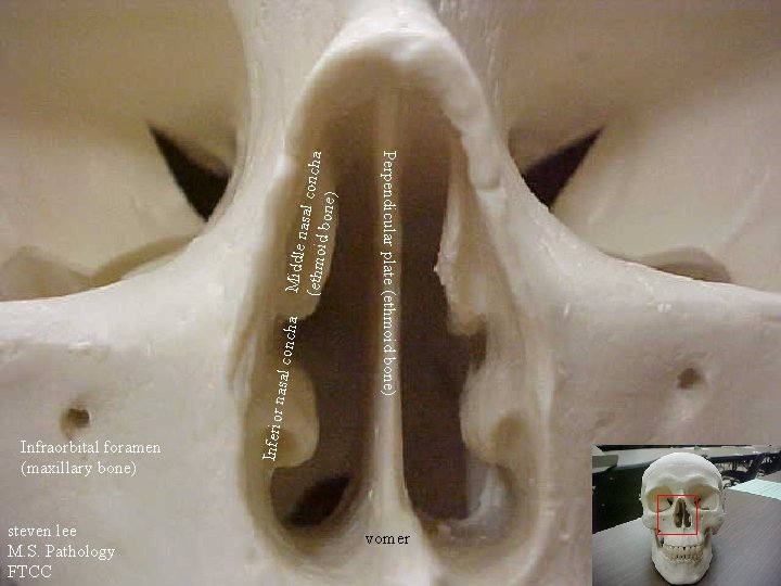 Middle na (ethmoi sal concha d bone) ncha Inferior nasal co steven lee M.