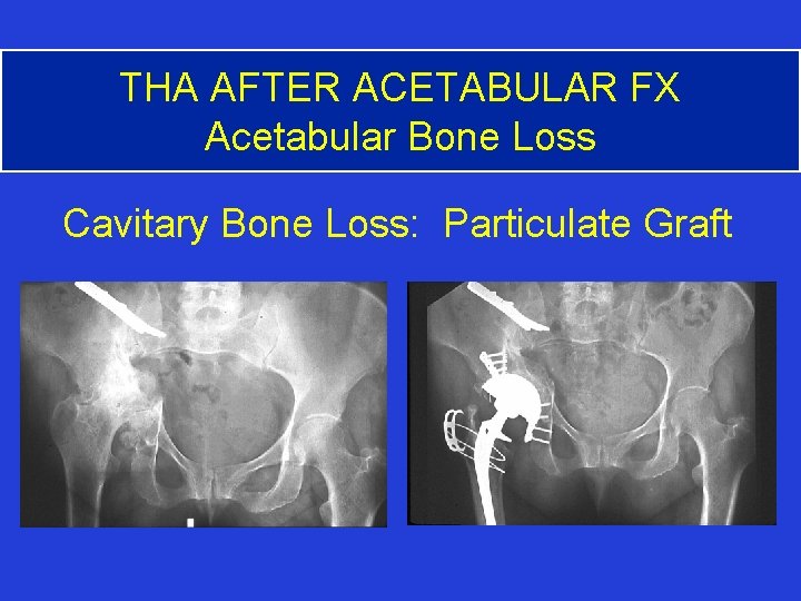 THA AFTER ACETABULAR FX Acetabular Bone Loss Cavitary Bone Loss: Particulate Graft 