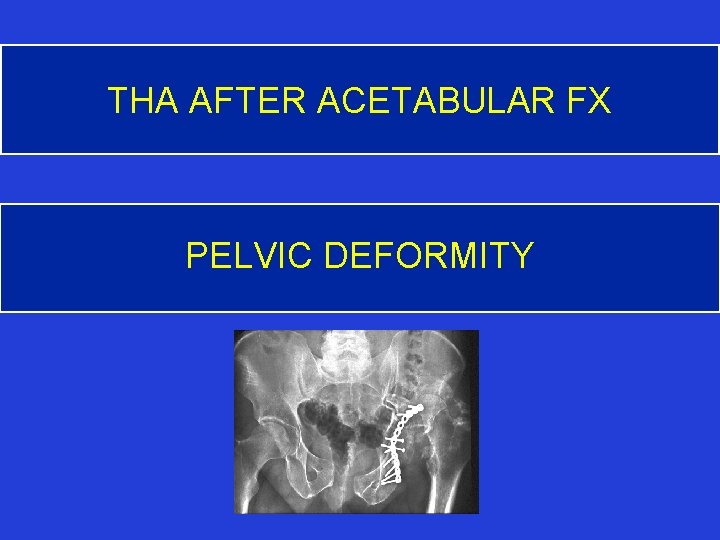 THA AFTER ACETABULAR FX PELVIC DEFORMITY 