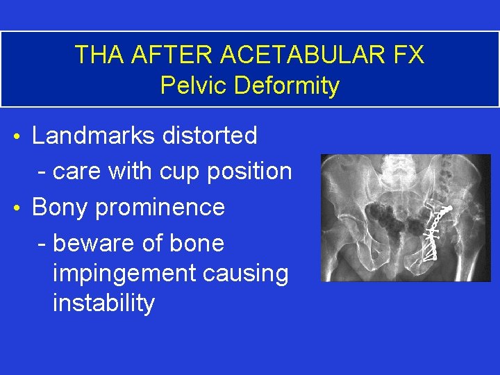 THA AFTER ACETABULAR FX Pelvic Deformity • Landmarks distorted - care with cup position