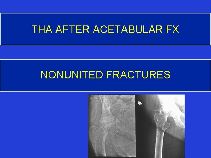 THA AFTER ACETABULAR FX NONUNITED FRACTURES 