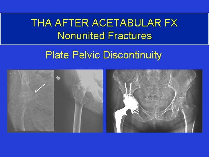 THA AFTER ACETABULAR FX Nonunited Fractures Plate Pelvic Discontinuity 