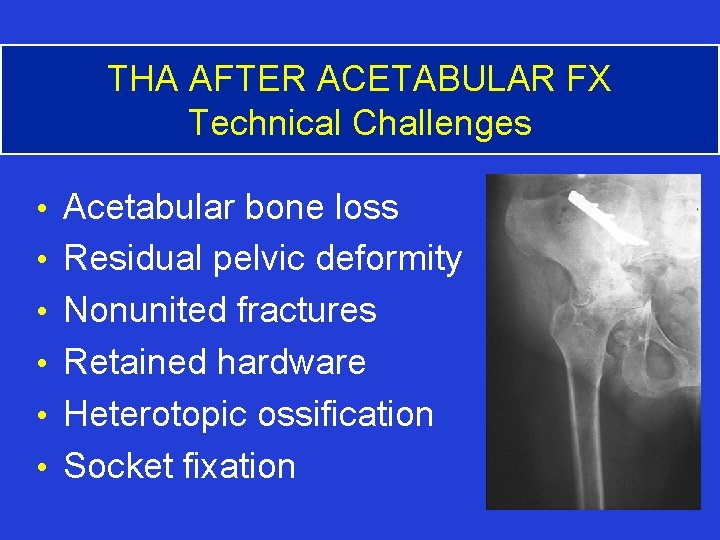 THA AFTER ACETABULAR FX Technical Challenges • Acetabular bone loss • Residual pelvic deformity