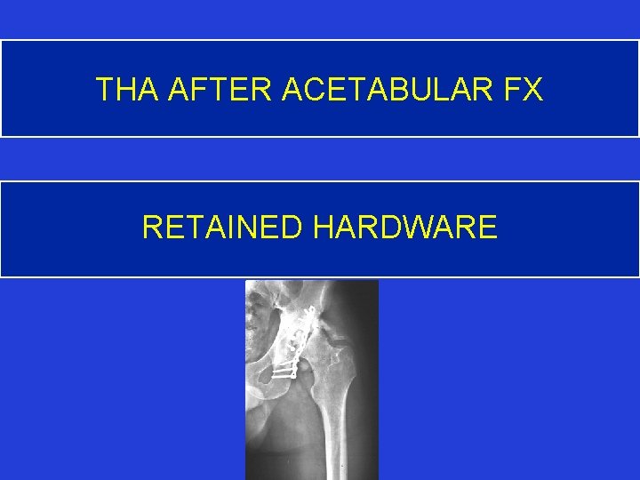 THA AFTER ACETABULAR FX RETAINED HARDWARE 