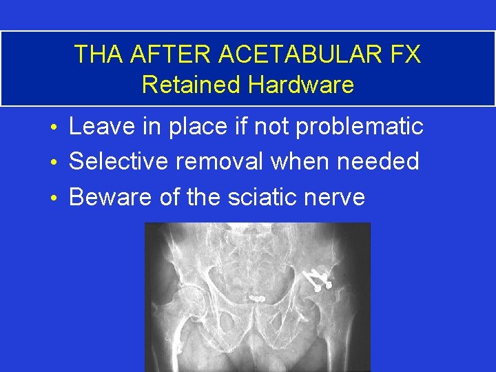 THA AFTER ACETABULAR FX Retained Hardware • Leave in place if not problematic •