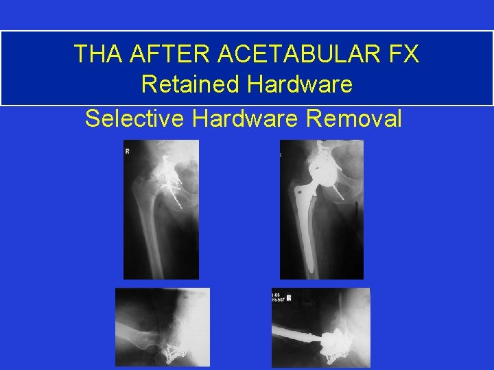 THA AFTER ACETABULAR FX Retained Hardware Selective Hardware Removal 