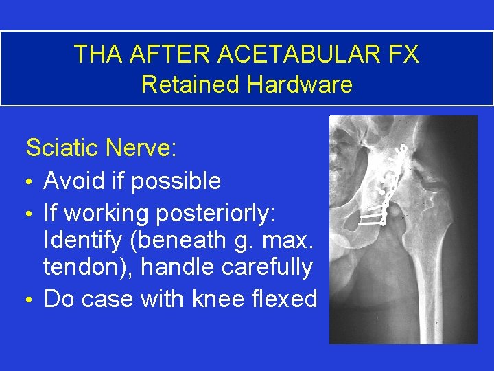 THA AFTER ACETABULAR FX Retained Hardware Sciatic Nerve: • Avoid if possible • If