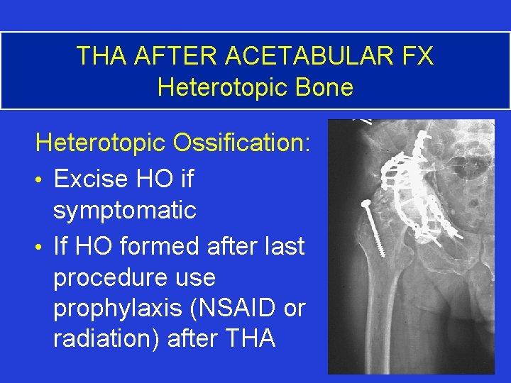 THA AFTER ACETABULAR FX Heterotopic Bone Heterotopic Ossification: • Excise HO if symptomatic •