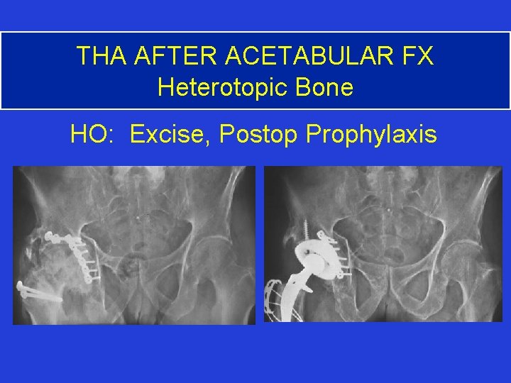 THA TO SALVAGE FAILED ACETABULAR FRACTURES Daniel J