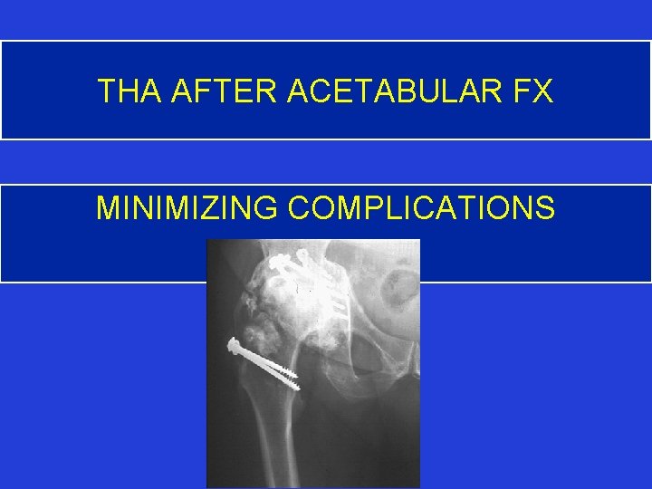 THA AFTER ACETABULAR FX MINIMIZING COMPLICATIONS 