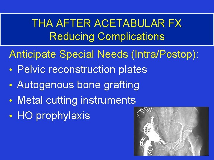THA AFTER ACETABULAR FX Reducing Complications Anticipate Special Needs (Intra/Postop): • Pelvic reconstruction plates