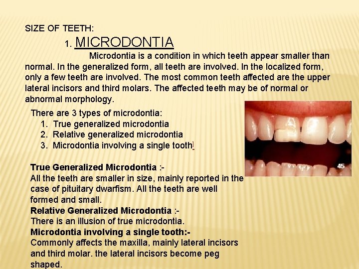 SIZE OF TEETH: 1. MICRODONTIA Microdontia is a condition in which teeth appear smaller