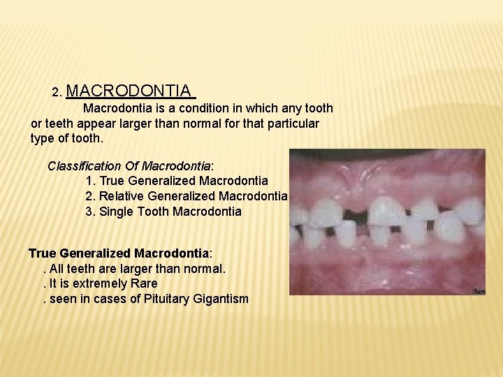 2. MACRODONTIA Macrodontia is a condition in which any tooth or teeth appear larger
