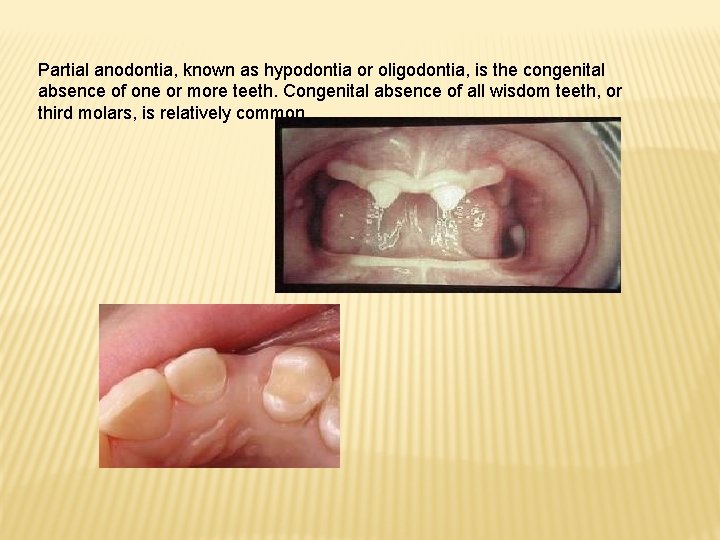 Partial anodontia, known as hypodontia or oligodontia, is the congenital absence of one or