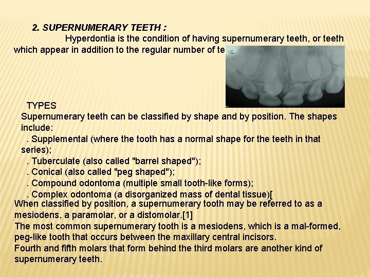 2. SUPERNUMERARY TEETH : Hyperdontia is the condition of having supernumerary teeth, or teeth