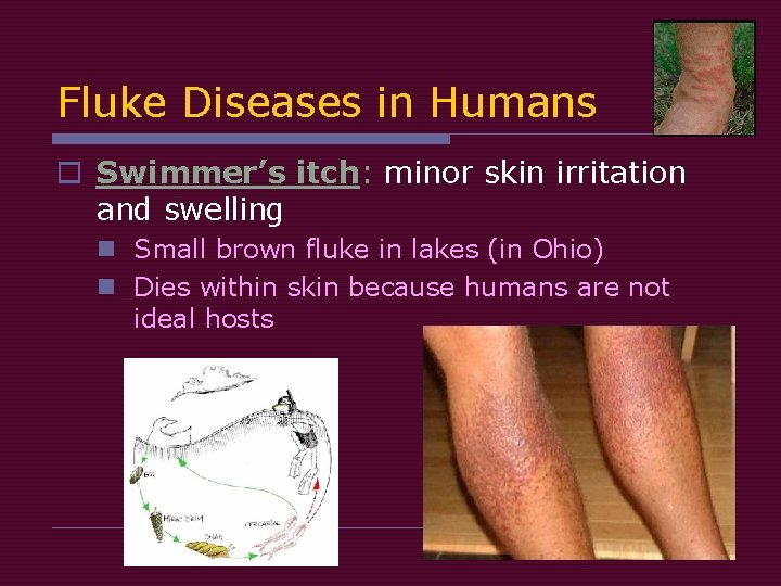 Fluke Diseases in Humans o Swimmer’s itch: minor skin irritation and swelling n Small