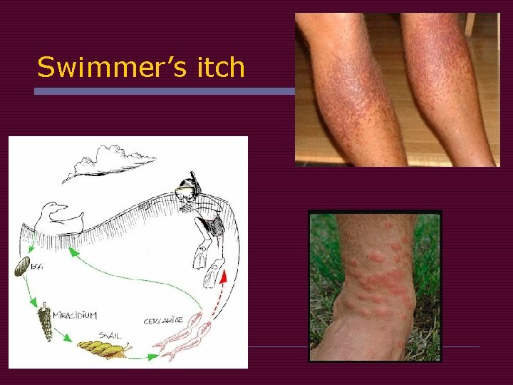 Swimmer’s itch 