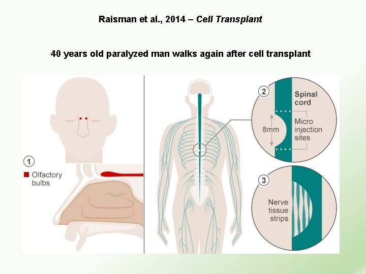 Raisman et al. , 2014 – Cell Transplant 40 years old paralyzed man walks