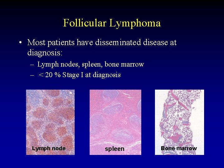 Follicular Lymphoma • Most patients have disseminated disease at diagnosis: – Lymph nodes, spleen,