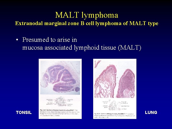 MALT lymphoma Extranodal marginal zone B cell lymphoma of MALT type • Presumed to