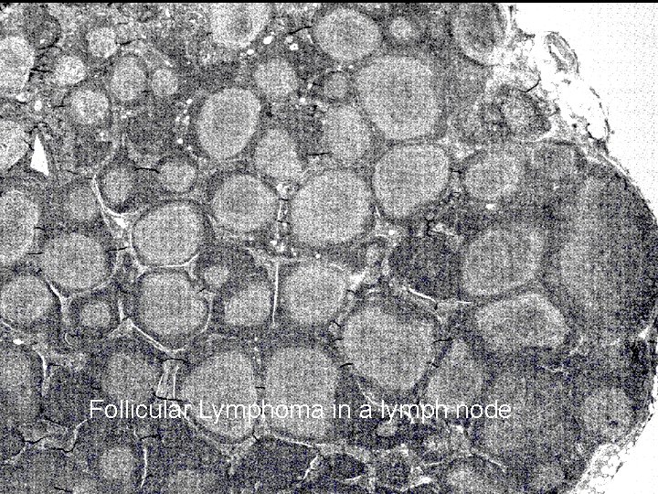 Follicular Lymphoma in a lymph node 