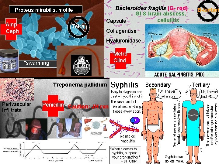 Proteus mirabilis, motile Amp Ceph Tetra Bacteroides fragilis (G- rod) GI & brain abscess,