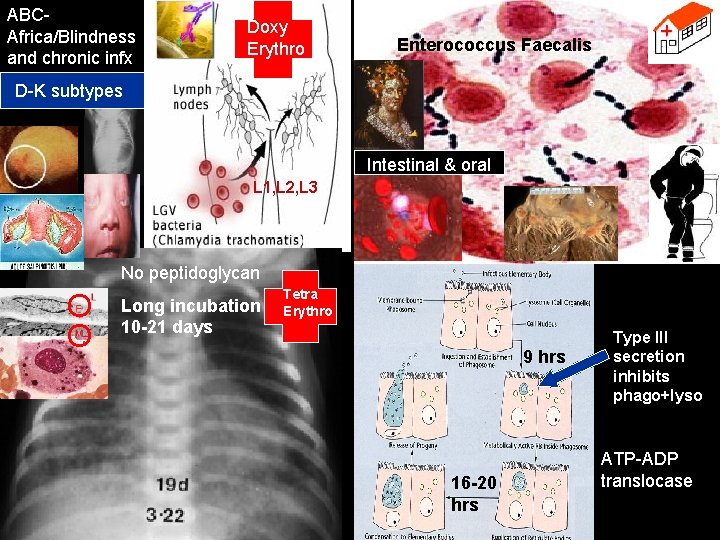 ABCAfrica/Blindness and chronic infx Doxy Erythro Enterococcus Faecalis D-K subtypes Intestinal & oral L