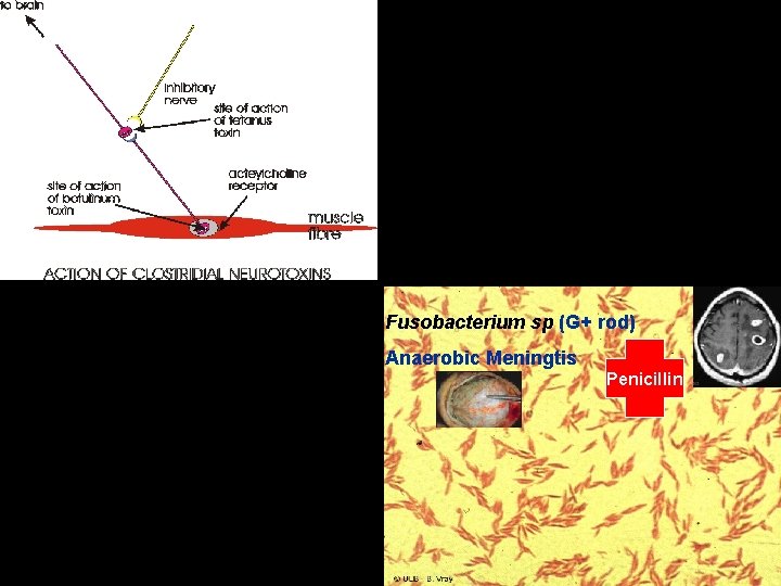 Fusobacterium sp (G+ rod) Anaerobic Meningtis Penicillin 