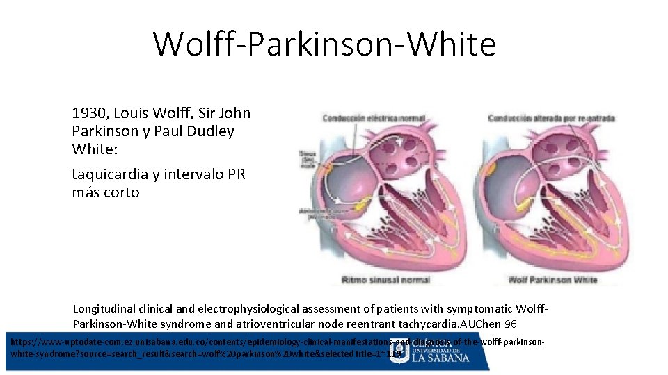 Wolff-Parkinson-White 1930, Louis Wolff, Sir John Parkinson y Paul Dudley White: taquicardia y intervalo