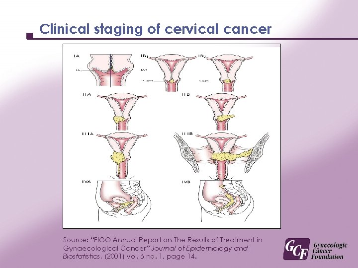Clinical staging of cervical cancer Source: “FIGO Annual Report on The Results of Treatment