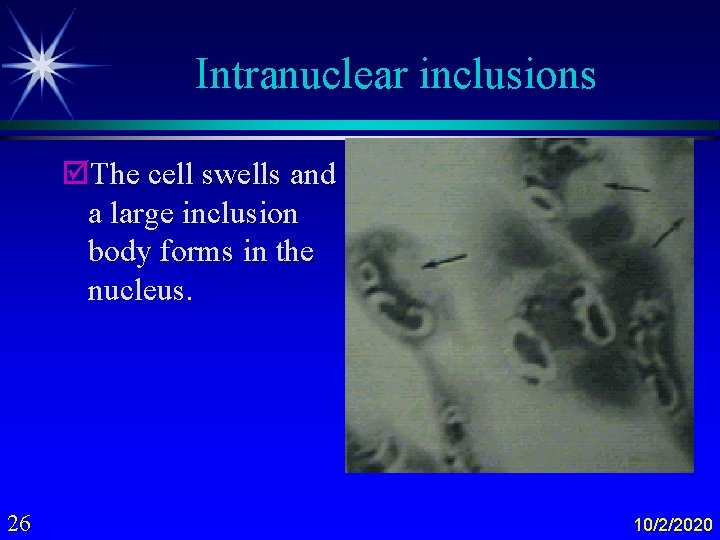 Intranuclear inclusions þThe cell swells and a large inclusion body forms in the nucleus.