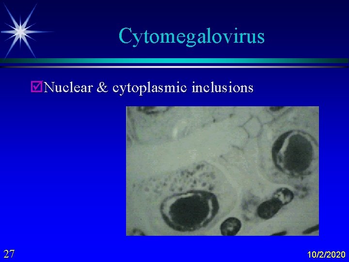 Cytomegalovirus þNuclear & cytoplasmic inclusions 27 10/2/2020 