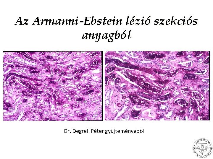 Az Armanni-Ebstein lézió szekciós anyagból Dr. Degrell Péter gyűjteményéből 