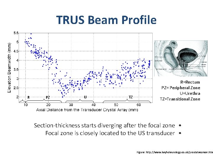 TRUS Beam Profile R PZ U TZ R=Rectum PZ= Peripheral Zone U=Urethra TZ=Transitional Zone