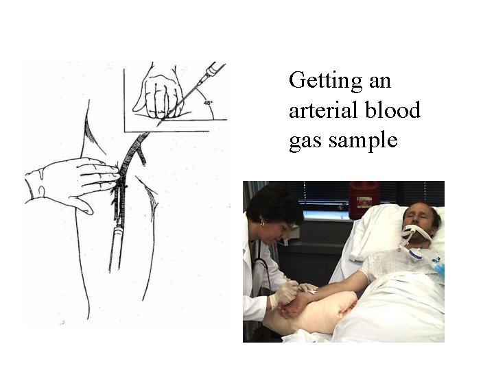 Getting an arterial blood gas sample 