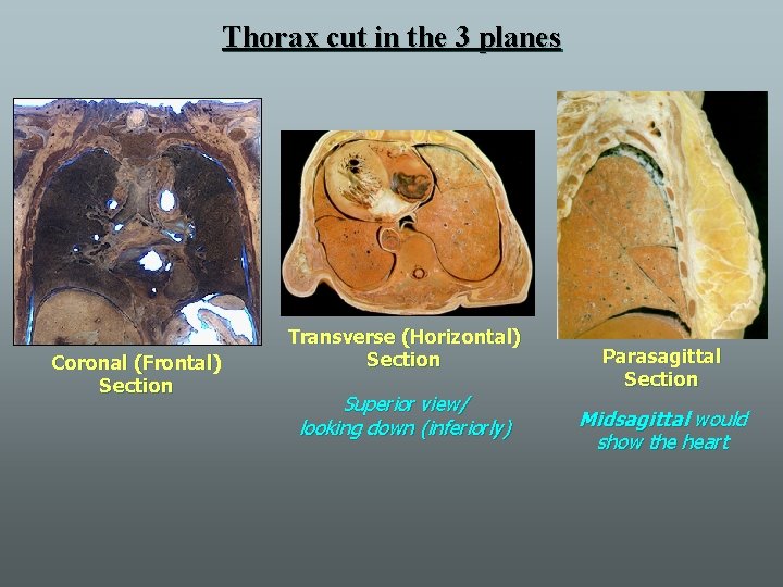 Thorax cut in the 3 planes Coronal (Frontal) Section Transverse (Horizontal) Section Superior view/