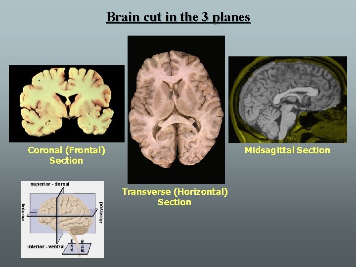 Brain cut in the 3 planes Coronal (Frontal) Section Midsagittal Section Transverse (Horizontal) Section