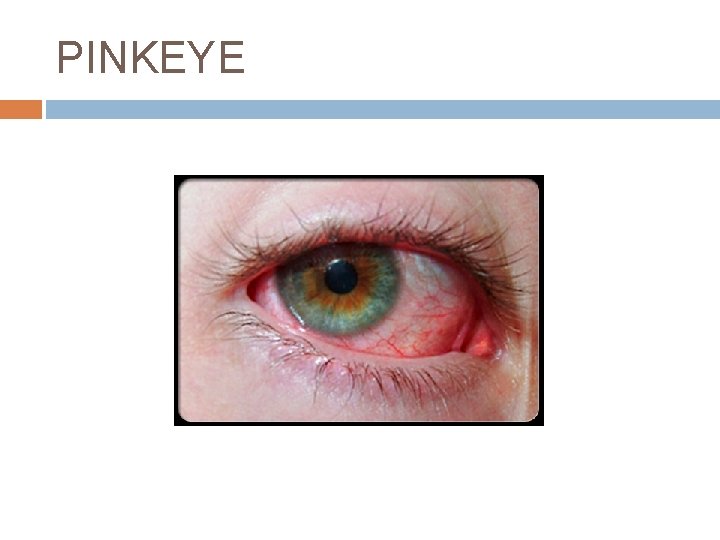 PINKEYE 