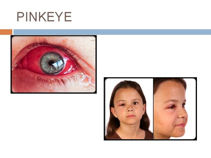 PINKEYE 