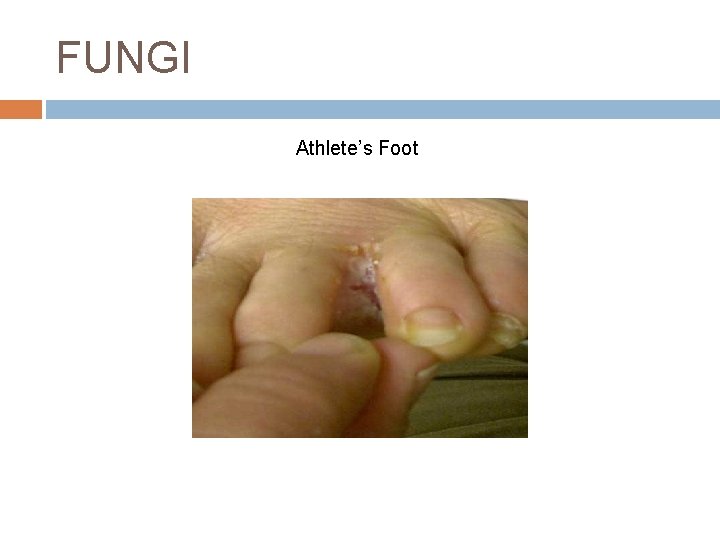 FUNGI Athlete’s Foot 